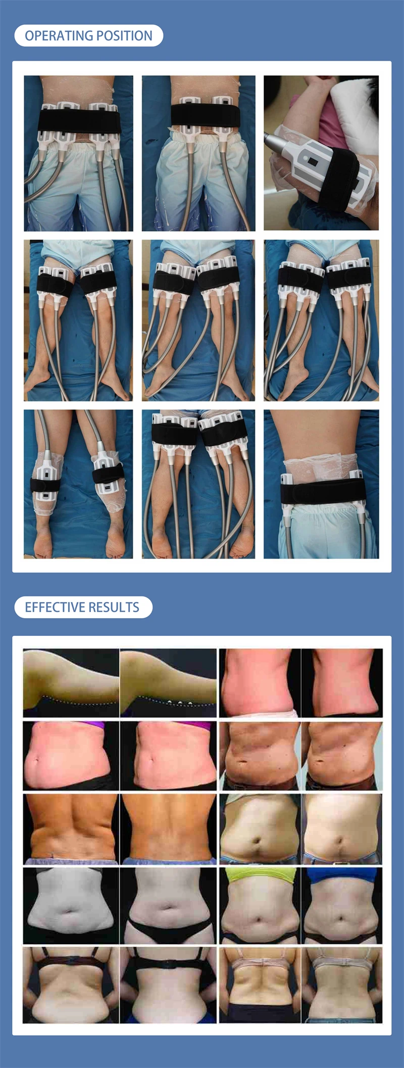 8 handle cryotherapy slimming