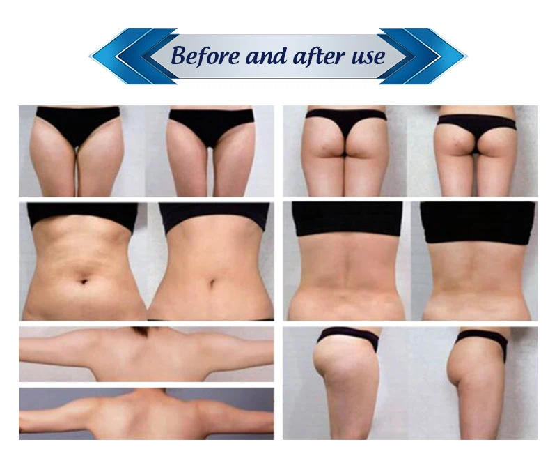 rf skin tightening slimming