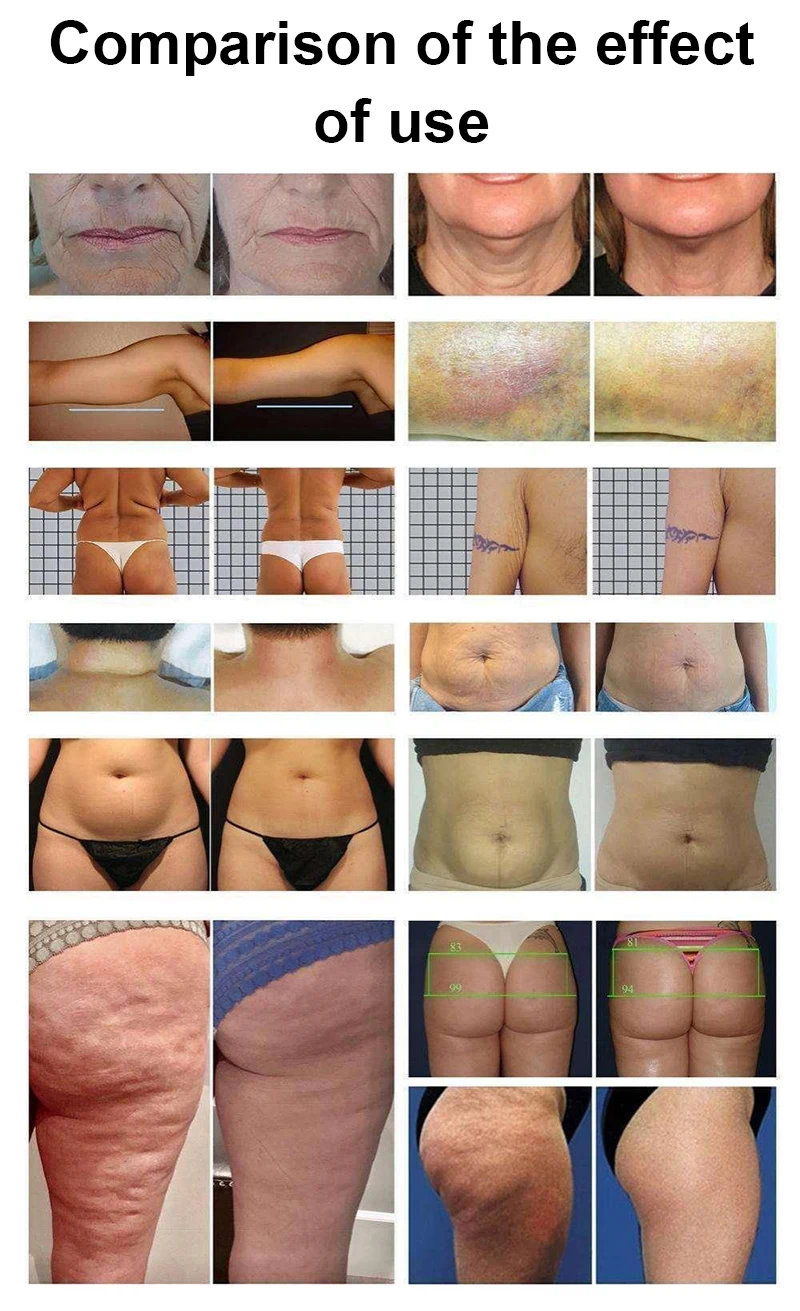 cellulite reduction roller rf