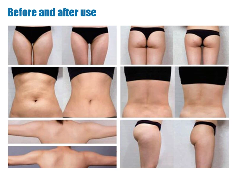 cellulite reduction treatment
