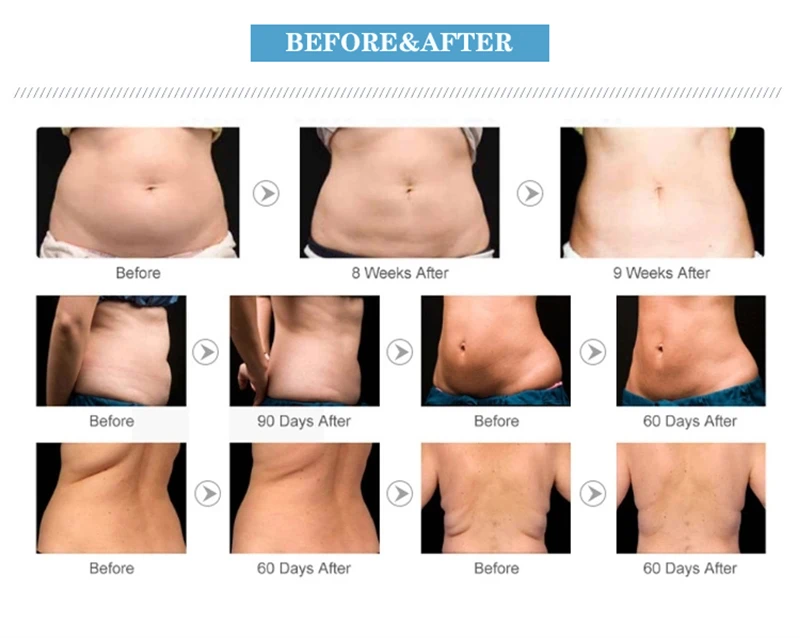 vacuum fat removal machine