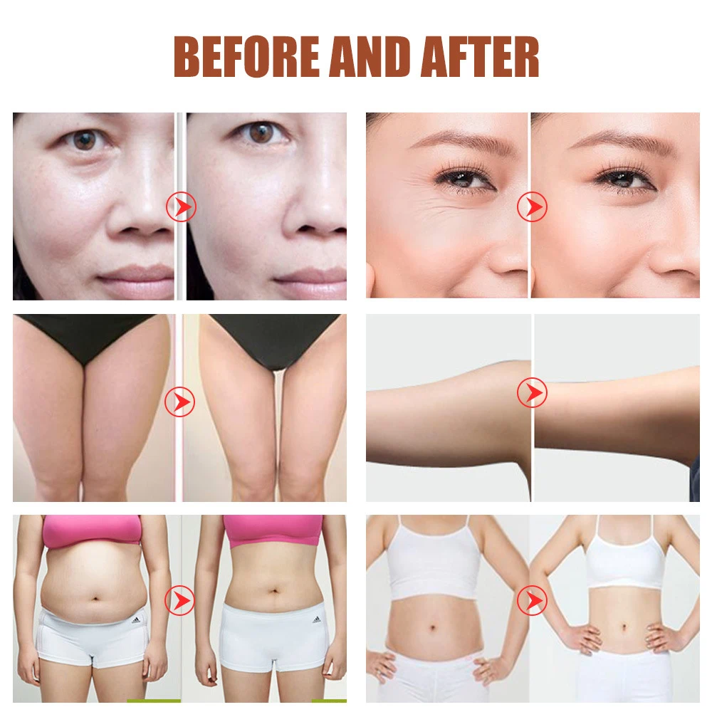 bipolar rf anti aging device