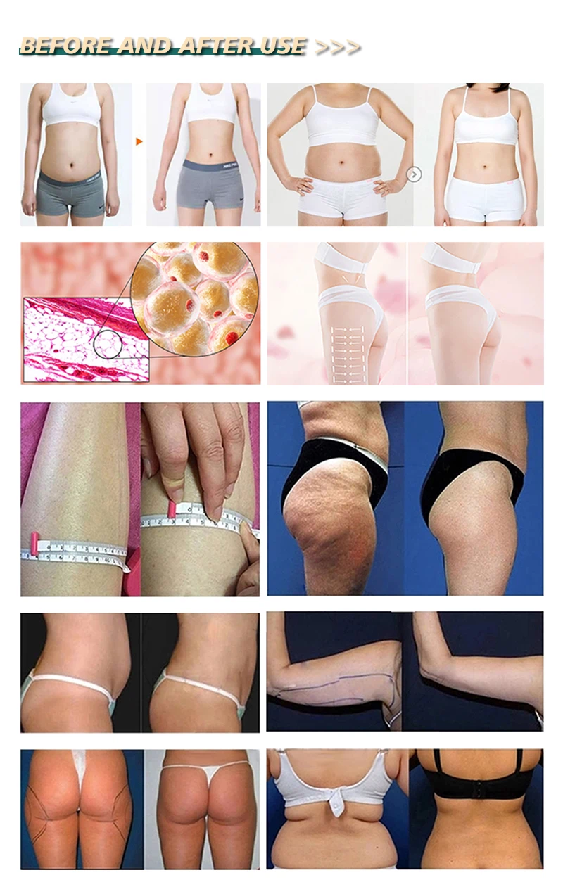 laser lipo cavitation system