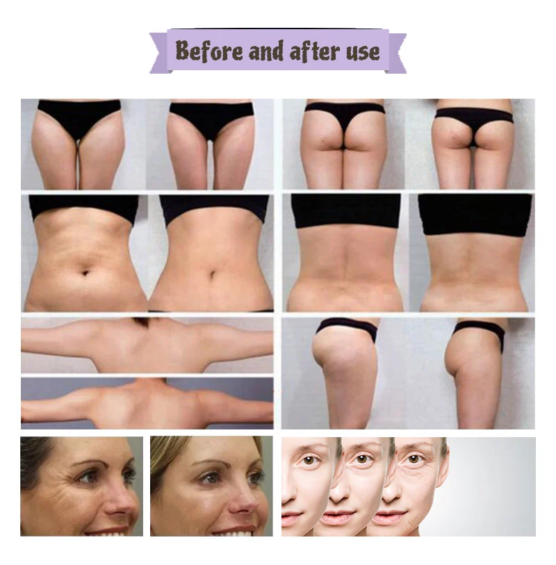 body shaping cavitation rf