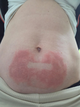 frostbite