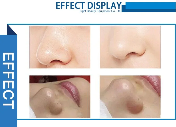 non-invasive skin exfoliation